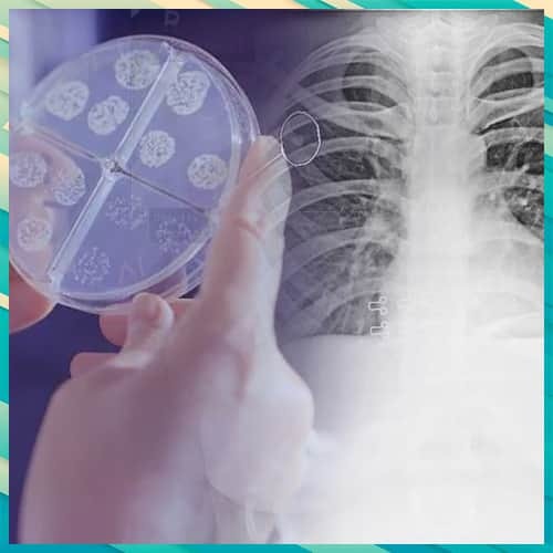 India to get AI aided X-ray device that can detect tuberculosis within a minute